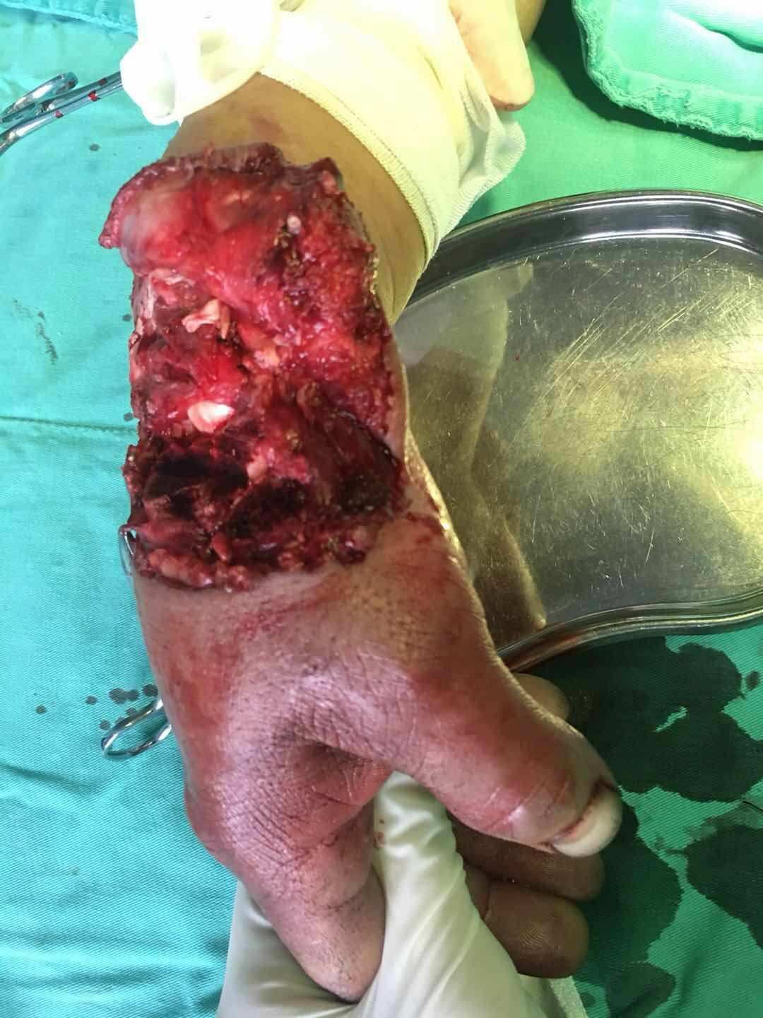 交通意外引起的肝破裂脾破裂属于_简述外伤性肝脾破裂的急救流程_外伤性肝脾破裂